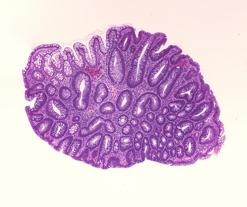 Les polypes intestinaux - clinique1037