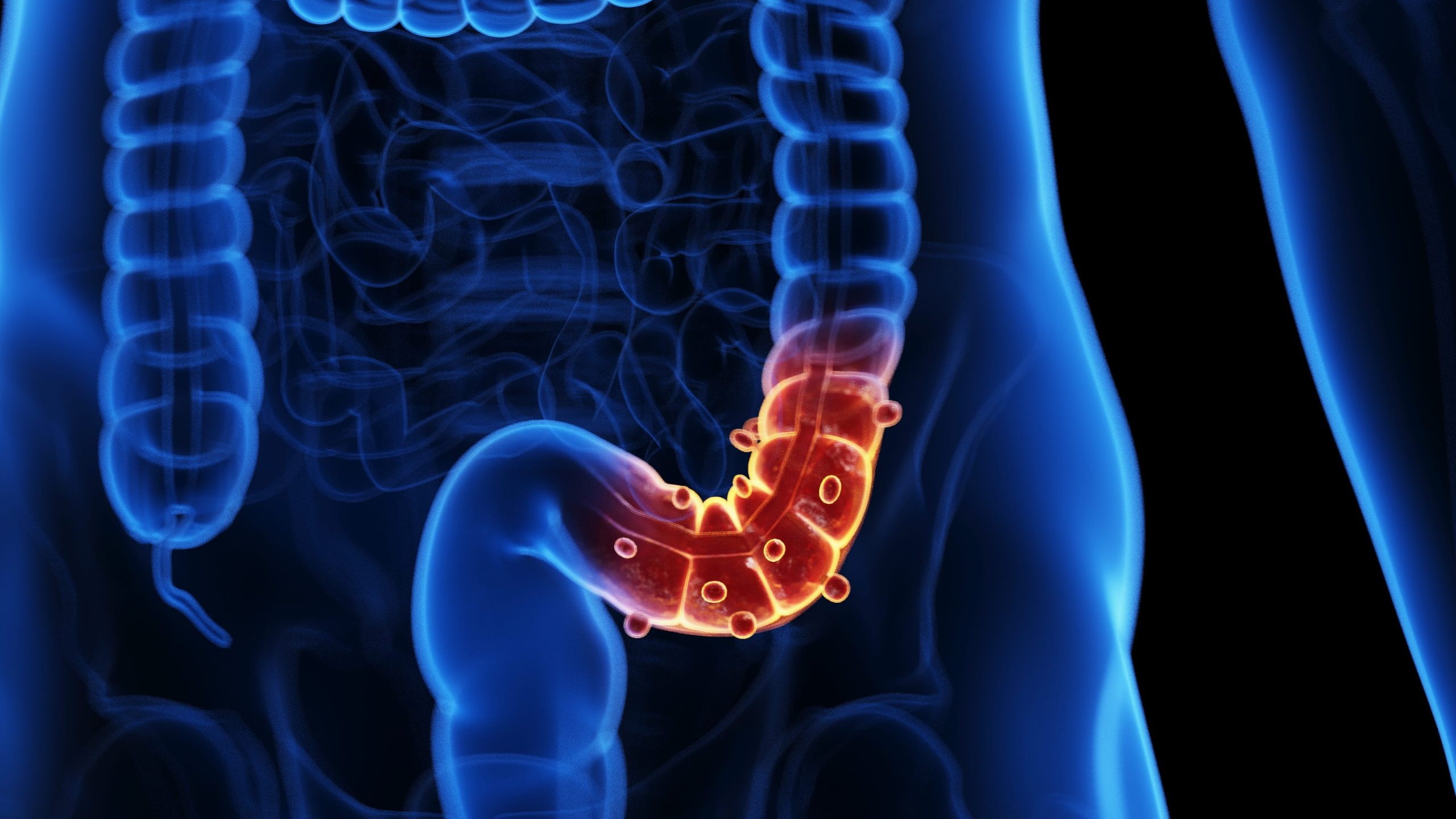 Illustration 3D de la diverticulite atteignant le colon